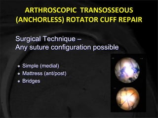 ARTHROSCOPIC TRANSOSSEOUS 
(ANCHORLESS) ROTATOR CUFF REPAIR 
Surgical Technique – 
Any suture configuration possible 
 Simple (medial) 
 Mattress (ant/post) 
 Bridges 
 