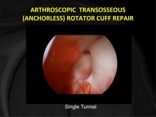 ARTHROSCOPIC TRANSOSSEOUS 
(ANCHORLESS) ROTATOR CUFF REPAIR 
Single Tunnel 
 