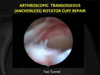 ARTHROSCOPIC TRANSOSSEOUS 
(ANCHORLESS) ROTATOR CUFF REPAIR 
Two Tunnel 
 