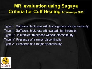MRI evaluation using Sugaya 
Criteria for Cuff Healing Arthroscopy 2005 
Type I: Sufficient thickness with homogeneously low intensity 
Type II: Sufficient thickness with partial high intensity 
Type III: Insufficient thickness without discontinuity 
Type IV: Presence of a minor discontinuity 
Type V: Presence of a major discontinuity 
 