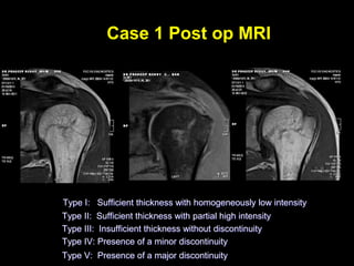 Case 1 Post op MRI 
Type I: Sufficient thickness with homogeneously low intensity 
Type II: Sufficient thickness with partial high intensity 
Type III: Insufficient thickness without discontinuity 
Type IV: Presence of a minor discontinuity 
Type V: Presence of a major discontinuity 
 