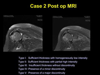 Case 2 Post op MRI 
Type I: Sufficient thickness with homogeneously low intensity 
Type II: Sufficient thickness with partial high intensity 
Type III: Insufficient thickness without discontinuity 
Type IV: Presence of a minor discontinuity 
Type V: Presence of a major discontinuity 
 