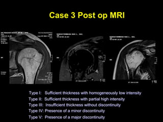 Case 3 Post op MRI 
Type I: Sufficient thickness with homogeneously low intensity 
Type II: Sufficient thickness with partial high intensity 
Type III: Insufficient thickness without discontinuity 
Type IV: Presence of a minor discontinuity 
Type V: Presence of a major discontinuity 
 