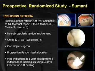 Prospective Randomized Study - Sumant 
INCLUSION CRITERIA 
Posterosuperior rotator cuff tear amenable 
to GT footprint repair without tension (L , 
Crescent, reverse L) 
• No subscapularis tendon involvement 
• Grade I, II, III (Goutallier) FI 
• One single surgeon 
• Prospective Randomized allocation 
• MRI evaluation at 1 year postop from 3 
independent radiologists using Sugaya 
Criteria for cuff healing 
 
