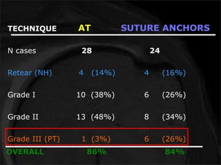 TECHNIQUE AT SUTURE ANCHORS 
N cases 28 24 
Retear (NH) 4 (14%) 4 (16%) 
Grade I 10 (38%) 6 (26%) 
Grade II 13 (48%) 8 (34%) 
Grade III (PT) 1 (3%) 6 (26%) 
OVERALL 86% 84% 
 