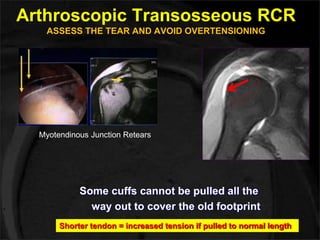 Arthroscopic Transosseous RCR 
ASSESS THE TEAR AND AVOID OVERTENSIONING 
Myotendinous Junction Retears 
Some cuffs cannot be pulled all the 
way out to cover the old footprint 
Shorter tendon = increased tension if pulled to normal length 
 