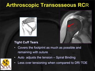 Arthroscopic Transosseous RCR 
Tight Cuff Tears 
• Covers the footprint as much as possible and 
remaining with suture 
• Auto adjusts the tension – Spiral Binding 
• Less over tensioning when compared to DR/ TOE 
 