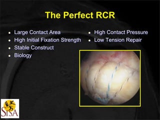 The Perfect RCR 
 Large Contact Area 
 High Initial Fixation Strength 
 Stable Construct 
 Biology 
 High Contact Pressure 
 Low Tension Repair 
 