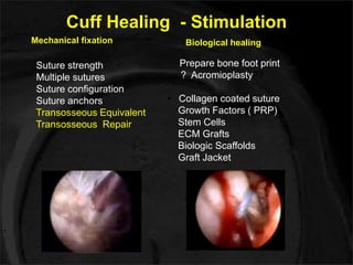 Cuff Healing - Stimulation 
Mechanical fixation Biological healing 
Suture strength 
Multiple sutures 
Suture configuration 
Suture anchors 
Transosseous Equivalent 
Transosseous Repair 
Prepare bone foot print 
? Acromioplasty?? 
• Collagen coated suture 
Growth Factors ( PRP) 
Stem Cells 
ECM Grafts 
Biologic Scaffolds 
Graft Jacket 
 