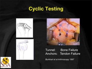 Cyclic Testing 
Tunnel: Bone Failure 
Anchors: Tendon Failure 
Burkhart et al Arthroscopy 1997 
 