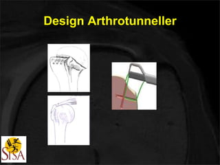 Design Arthrotunneller 
 