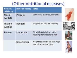 (Other nutritional diseases)
Nutrient
deficiency
Name of disease Notes
Niacin
(Vit B3)
Pellagra Dermatitis, diarrhea, dementia
Thiamin
(Vit B1)
Beriberi Weight loss, fatigue, swelling
Protein Marasmus Weight loss in infants after
weaning from mother’s milk
Kwashiorkor Weight loss in infants with high
starch low protein diets
 