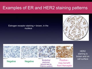 Examples of ER and HER2 staining patterns
15
HER2
staining is
brown and on
cell surface
Estrogen receptor staining = brown, in the
nucleus
 