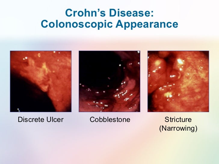 IBD irritated?