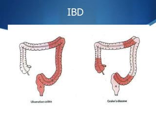 Ibd Pocus Management of Inflammatory Bowel Disease | PPT