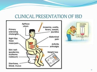 CLINICAL PRESENTATION OF IBD
17
 