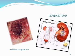 Cobblestone appearance
NEPHROLITIASIS
28
 