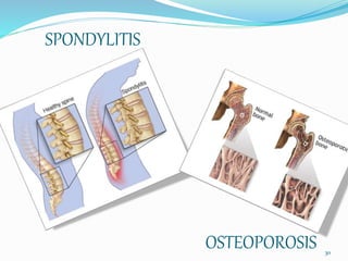 SPONDYLITIS
OSTEOPOROSIS 30
 