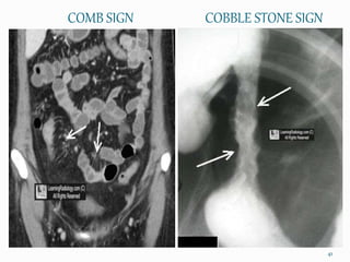 COMB SIGN
41
COBBLE STONE SIGN
 
