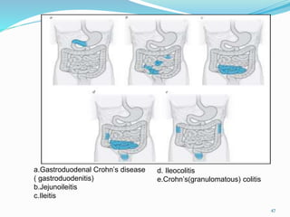 a.Gastroduodenal Crohn’s disease
( gastroduodenitis)
b.Jejunoileitis
c.Ileitis
47
d. Ileocolitis
e.Crohn’s(granulomatous) colitis
 
