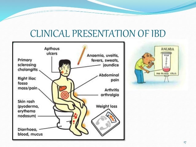 Inflammatory Bowel Disease