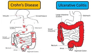 Ulcerative ColitisCrohn’s Disease
 