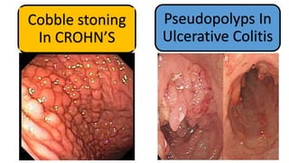 Cobble stoning
In CROHN’S
Pseudopolyps In
Ulcerative Colitis
 