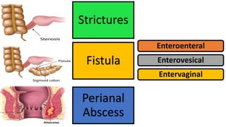 Fistula
Strictures
Perianal
Abscess
Enteroenteral
Enterovesical
Entervaginal
 