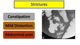 Strictures
Constipation
Mild Distention
Abdominal pain
 