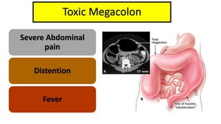 Toxic Megacolon
Severe Abdominal
pain
Distention
Fever
 