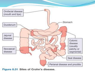 inflammatory bowel disease (IBD) | PPTX