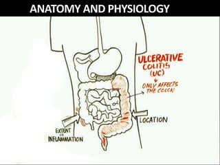 Inflammatory Bowel Disease(IBD). | PPTX