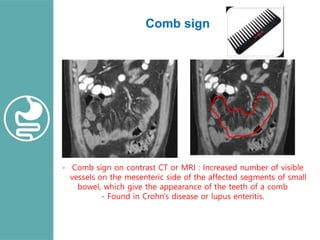 Comb Signct inflammatory bowel diseases, what`s new ? | PPTX