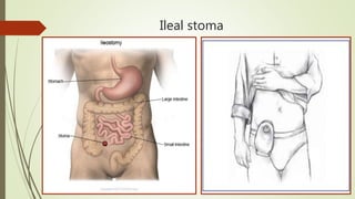 Ileal stoma
 
