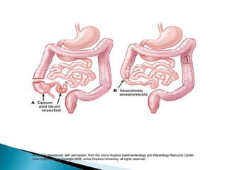 Artwork is reproduced, with permission, from the Johns Hopkins Gastroenterology and Hepatology Resource Center,Artwork is reproduced, with permission, from the Johns Hopkins Gastroenterology and Hepatology Resource Center,
www.hopkins-gi.org,copyright 2006, Johns Hopkins University, all rights reserved.www.hopkins-gi.org,copyright 2006, Johns Hopkins University, all rights reserved.
 