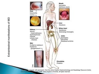 Artwork is reproduced, with permission, from the Johns Hopkins Gastroenterology and Hepatology Resource Center,Artwork is reproduced, with permission, from the Johns Hopkins Gastroenterology and Hepatology Resource Center,
www.hopkins-gi.org,copyright 2006, Johns Hopkins University, all rights reserved.www.hopkins-gi.org,copyright 2006, Johns Hopkins University, all rights reserved.
ExtraintestinalmanifestationsofIBD
 