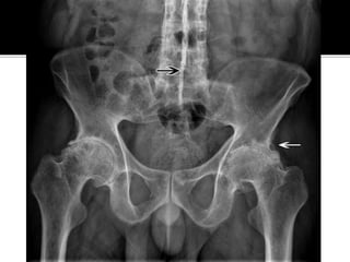 Extraintestinal Manifestations OF IBD Inflammatory Bowel Disease : A ...