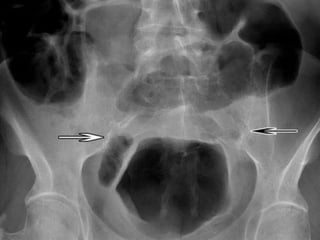 Extraintestinal Manifestations OF IBD Inflammatory Bowel Disease : A ...