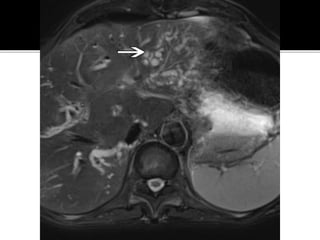 Extraintestinal Manifestations OF IBD Inflammatory Bowel Disease : A ...