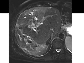 Extraintestinal Manifestations OF IBD Inflammatory Bowel Disease : A ...