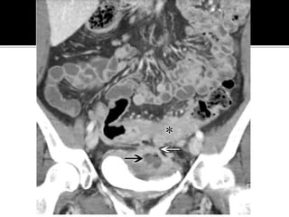 Extraintestinal Manifestations OF IBD Inflammatory Bowel Disease : A ...