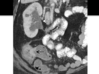 Extraintestinal Manifestations OF IBD Inflammatory Bowel Disease : A ...