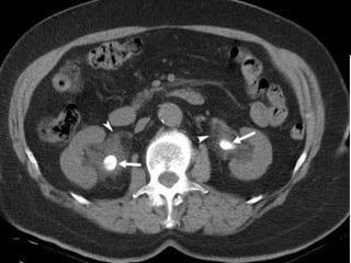 Extraintestinal Manifestations OF IBD Inflammatory Bowel Disease : A ...
