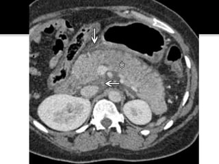 Extraintestinal Manifestations OF IBD Inflammatory Bowel Disease : A ...