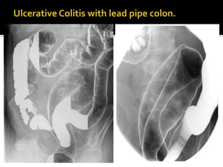 Extraintestinal Manifestations OF IBD Inflammatory Bowel Disease : A ...