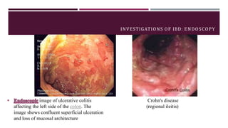 MANAGEMENT OF ULCERATIVE COLITIS
 Avoidance of opiates & anti-diarrhoeal agents (can be given in mild cases)
 Consider m...