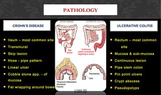 PATHOLOGY
CROHN’S DISEASE ULCERATIVE COLITIS
 Ileum – most common siteIleum – most common site
 TransmuralTransmural
 Skip lesionSkip lesion
 Hose - pipe patternHose - pipe pattern
 Linear ulcerLinear ulcer
 Cobble stone app. - ofCobble stone app. - of
mucosamucosa
 Fat wrapping around bowelFat wrapping around bowel
 Rectum – most commonRectum – most common
sitesite
 Mucosa & sub-mucosaMucosa & sub-mucosa
 Continuous lesionContinuous lesion
 Pipe stem colonPipe stem colon
 Pin point ulcersPin point ulcers
 Crypt abscessCrypt abscess
 PseudopolypsPseudopolyps
 