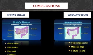 COMPLICATIONS
CROHN’S DISEASE ULCERATIVE COLITIS
 ObstructionObstruction
 PeritonitisPeritonitis
 PerianalPerianal
 Toxic megacolonToxic megacolon
 Massive HgeMassive Hge
 Fistula-in-anoFistula-in-ano
 