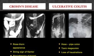 ULCERATIVE COLITISCROHN’S DISEASE
 Hose – pipe colonHose – pipe colon
 Toxic megacolonToxic megacolon
 Loss of haustrationsLoss of haustrations
 Rose-thornRose-thorn
appearanceappearance
 String sign of KantorString sign of Kantor
 