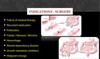 CROHN’S DISEASE
 Failure of medical therapyFailure of medical therapy
 Recurrent obstructionRecurrent obstruction
 PerforationPerforation
 Fistula / Abscess / StrictureFistula / Abscess / Stricture
 HemorrhageHemorrhage
 Steroid dependency diseaseSteroid dependency disease
 Growth retardation (children)Growth retardation (children)
 Malignant changeMalignant change
INDICATIONS - SURGERY
 